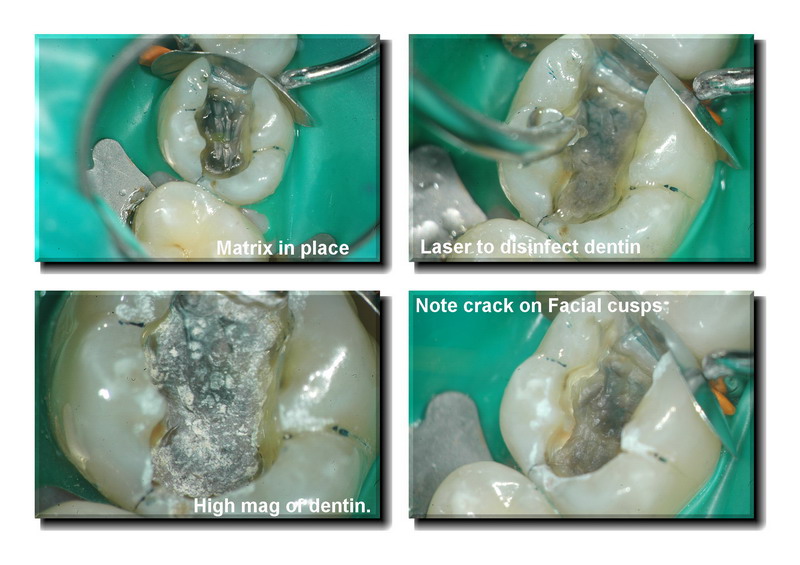 Cracked tooth pg 4 edited_resize.jpg